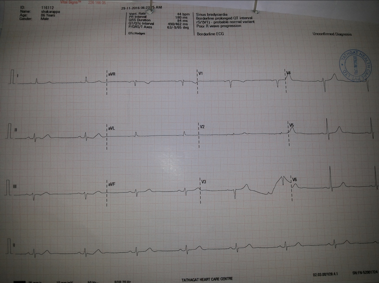 Diagnose The ECG Of 86 Yr Old Patient